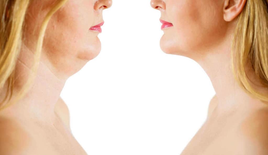 Double Chin treatment Clifton before and after results