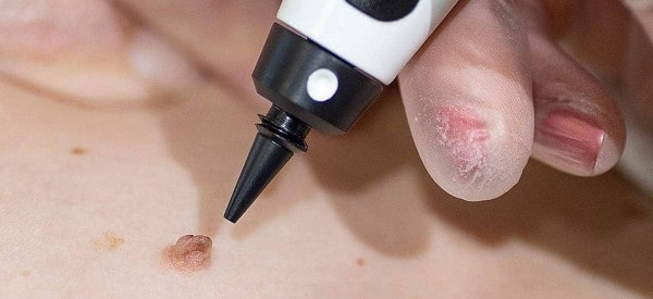 After Skin Tag Removal Clifton
