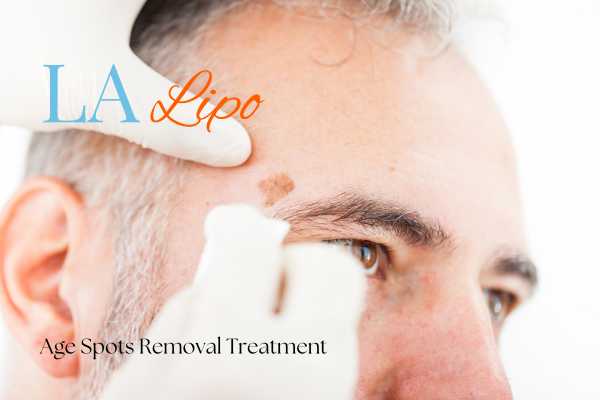 What Are the Most Effective Treatments for Age Spots Clifton?