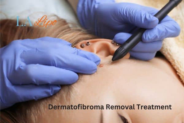 Dermatofibroma Removal Treatment Clifton