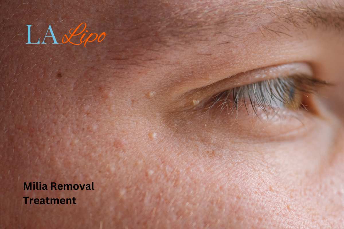 Cryopen Milia Removal: Is It the Easiest and Safest Option Clifton?