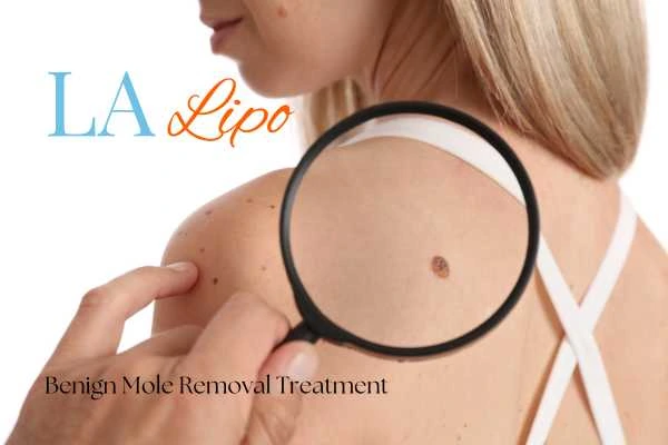 Why getting moles removed Clifton can boost your confidence!