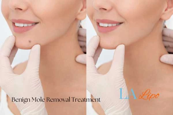 Woman's before and after results of being moles removal treatment Clifton