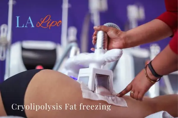 women getting fat freezing Clifton