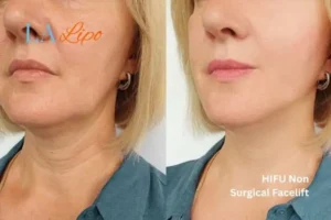 hi-fu for wrinkles Clifton before and after results