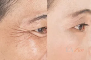 Before and after results of woman - HI-fu wrinkles reduction treatment Clifton