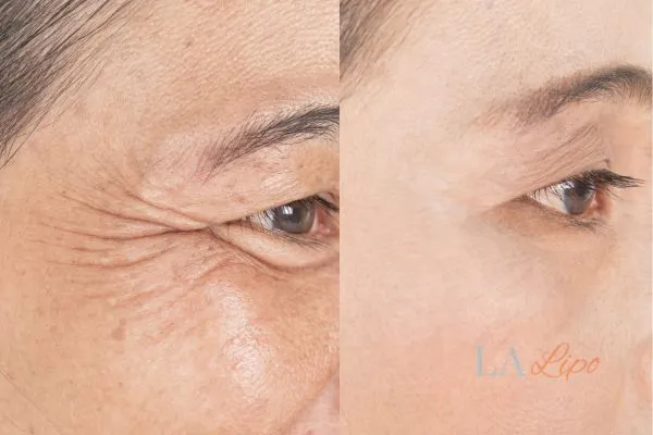 Before and after results of woman - HI-fu wrinkles reduction treatment Clifton