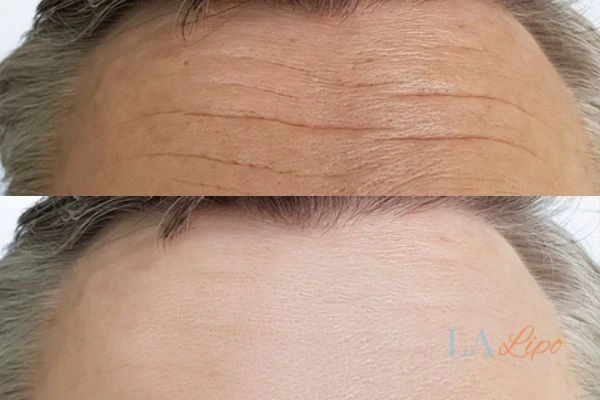 results of HIFU Clifton on mans forehead to help reduce lines and wrinkles