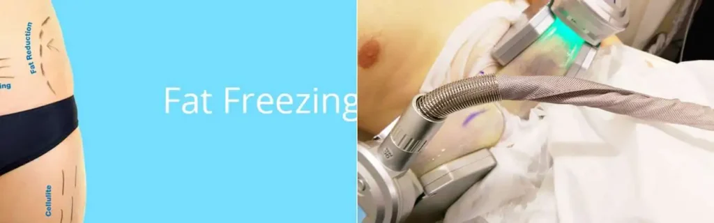 multi areas of a persons body having coolsculpting Clifton treatment