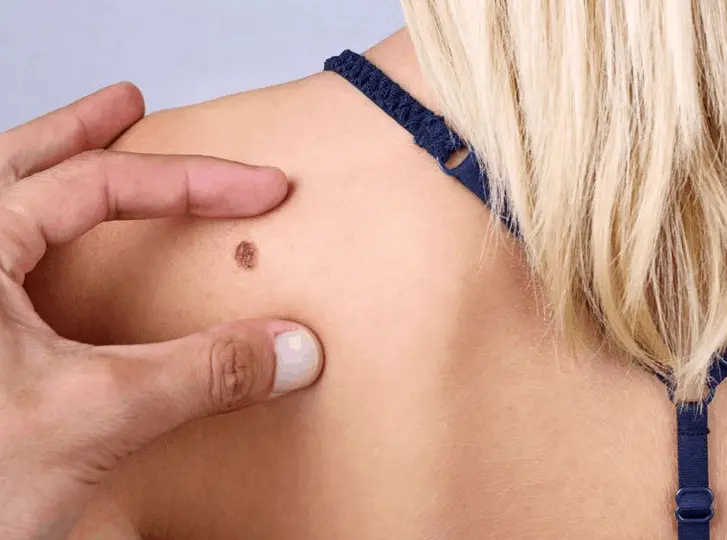 woman having mole removal Clifton consultation before treatment.