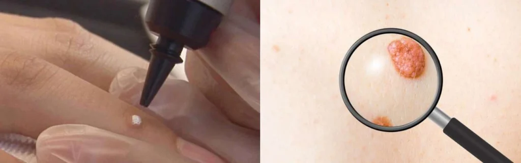 Person getting moles removed with cryopen Clifton