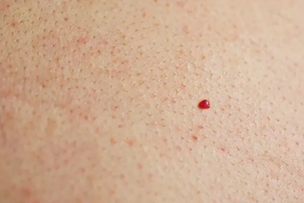 close up of a cherry angioma Clifton