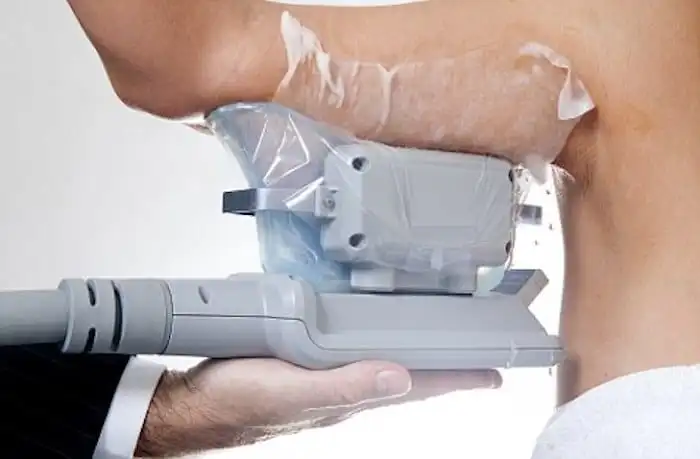 Picture of fat freezing Clifton on the upper arms.