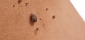 image of a skin tag Clifton