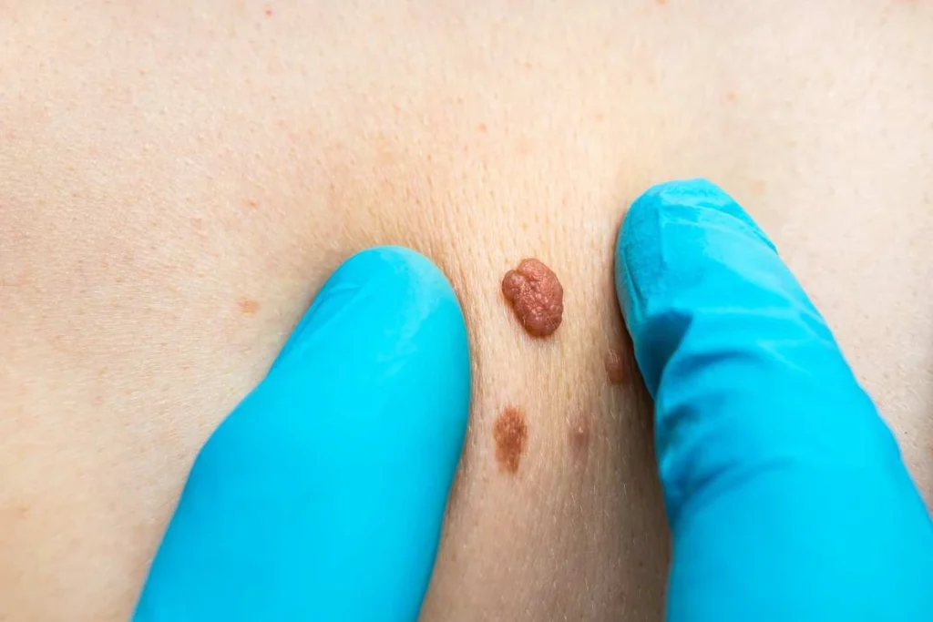 Consultant examining a skin tag Clifton