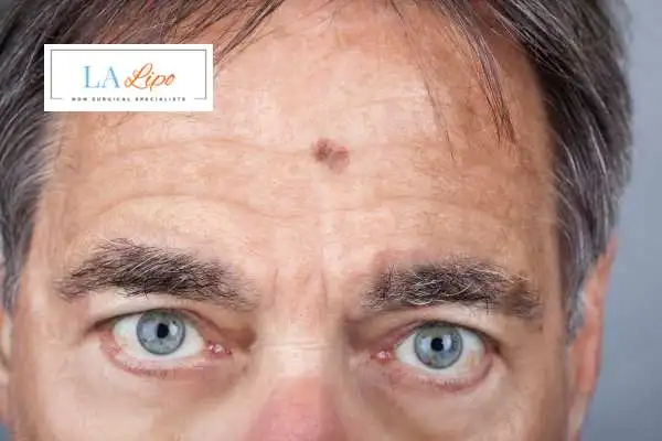 Solar Lentigo Removal Clifton image of man with mark on his forehead