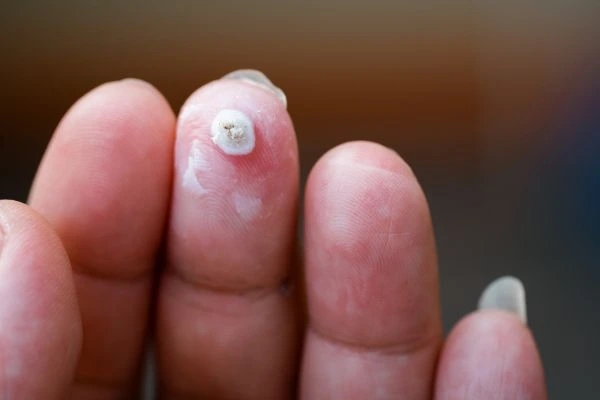 wart on person finger - cryotherapy to treat from LA LIPO Clifton