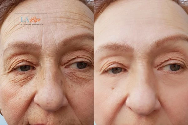 The powerful benefits of Morpheus8 Treatment Clifton - Call Our team today!
