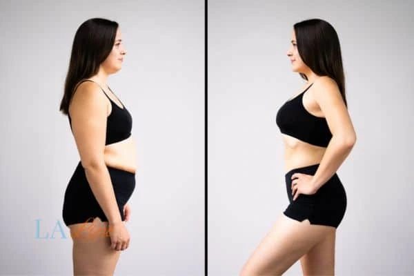 Picture of womans before and after using LA-EMS body sculpting to improve her core strength Clifton
