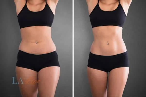 before and after results of non-surgical treatment to help a woman's body image and mental health Clifton