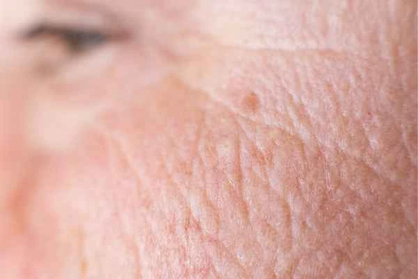 close up picture of a woman's face showing an age spot Clifton