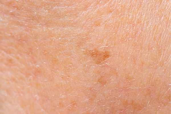 close up picture of age spots Clifton