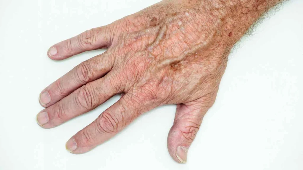 Male hand showing age spot Clifton