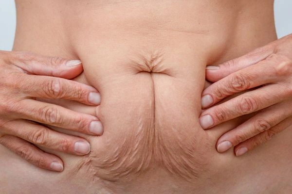 Image of a woman's stomach with loose skin - example of skin tightening Clifton options