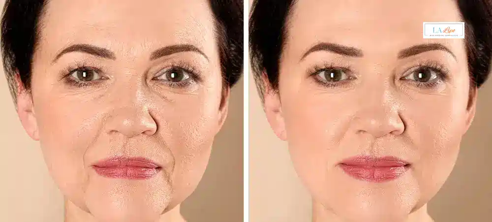 How Long Does It Take to See Results and How Long Do They Last Clifton?