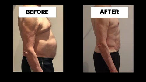 What Symptoms Can Diastasis Recti Cause in Men? Weak Core, Back Pain and Poor Posture Clifton